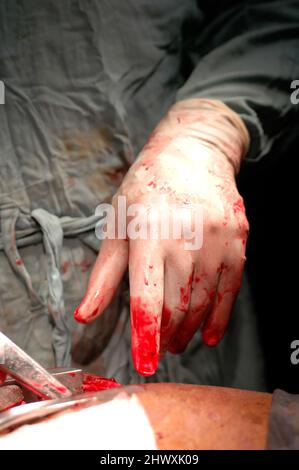 Nahaufnahme eines blutbefleckten chirurgischen Handschuhs während der Operation Stockfoto