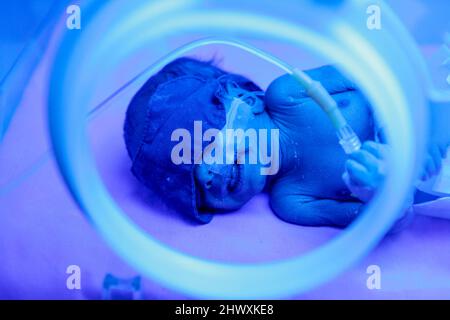 Ein Frühchen in einem Inkubator unter Phototherapie zur Behandlung von Gelbsucht. Gelbsucht wird durch die Ablagerung von überschüssigem Pigment (Bilirubin) in der Haut verursacht Stockfoto