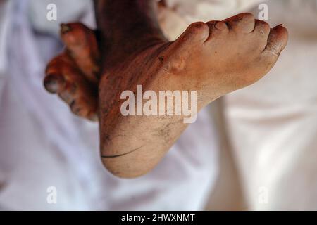 Die Füße eines jungen Mannes, der an Lepra leidet. Lepra ist eine chronisch entzündliche Erkrankung, die durch Mycobacterium leprae verursacht wird. Lepra schädigt die Nerven, Stockfoto