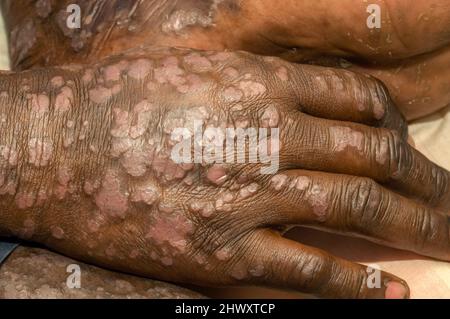 Ein Patient mit schwerer, ausgedehntes Psoriasis am ganzen Körper. Viele Patienten mit dermatologischen Symptomen weisen oft mehr als eine Pathologie auf, mak Stockfoto