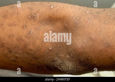 Der Arm eines Patienten mit leichter Psoriasis Psoriasis ist eine häufige, chronische rezidivierende/remittierende immun-vermittelte Hauterkrankung, die durch rotes, schuppiges p gekennzeichnet ist Stockfoto