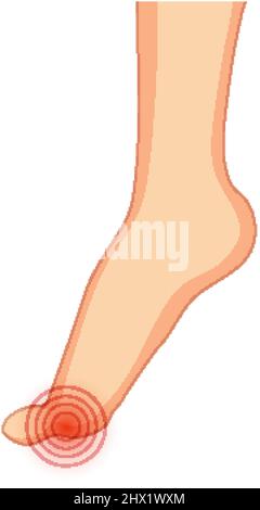 Hallux valgus Typen auf weißem Hintergrund Illustration Stock Vektor