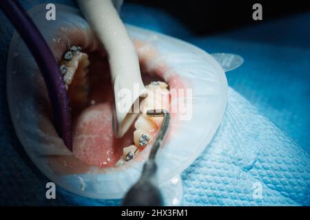 Draufsicht über den Prozess des Zähneputzen des Patienten. Zahnreinigung mit Wasserstrahl und Speichelauswerfer. Wangenaufroller auf den Lippen. Das Konzept von pro Stockfoto