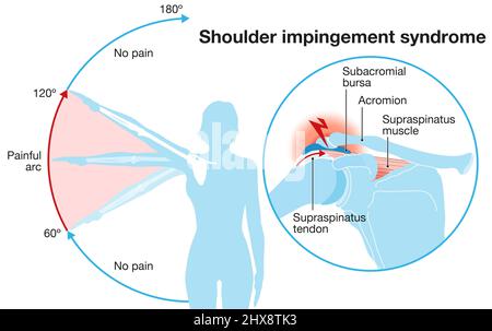 Abbildung zeigt das Schulter-Impingement-Syndrom und den schmerzhaften Lichtbogen Stockfoto