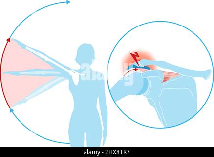 Abbildung zeigt das Schulter-Impingement-Syndrom und den schmerzhaften Lichtbogen Stockfoto