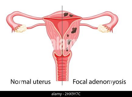 Fokale Adenomyose menschliche Anatomie weibliches reproduktives Krankheitssystem im Vergleich zu normal. Verglichen pädagogische gesunde und abnorme Anatomie Organe Uterus Symbol flache Cartoon Vektor Illustration isoliert Stock Vektor