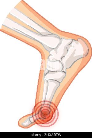 Hallux valgus Typen auf weißem Hintergrund Illustration Stock Vektor