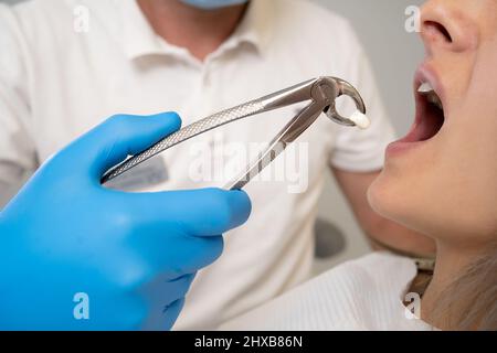 Nahaufnahme des Prozesses zum Entfernen eines Zahns aus der Mundhöhle. Der Arzt hält die Zange mit dem extrahierten Zahn in der Nähe des Kiefers des Klienten Stockfoto