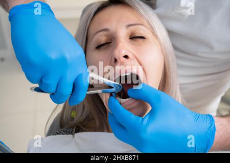 Nahaufnahme des Mundes des armen Mädchens im Lätzchen des Patienten in der Zahnklinik. Eine Zahnärztin in blauen Latexhandschuhen entfernt ihren Zahn mit einem bukkalen Retra Stockfoto