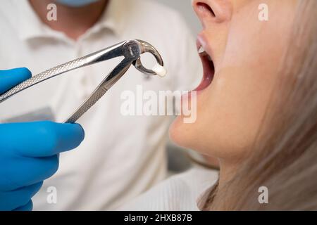 Nahaufnahme der Zeps zur Extraktion der Zähne und eines Zahnes in ihnen. Das Konzept, zum Zahnarzt zu gehen. Stockfoto