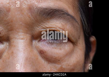 Prominenter Fettbeutel unter den Augen der älteren asiatischen Frau. Nahaufnahme. Stockfoto