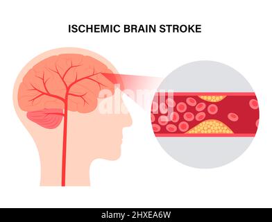 Ischämischer Schlaganfall, Illustration Stockfoto