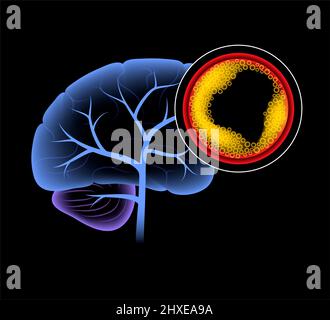 Ischämischer Schlaganfall, Illustration Stockfoto