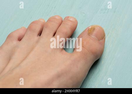 Zehennägel mit Pilzproblemen, Onychomykose, auch bekannt als Tinea unguium, ist eine Pilzinfektion des Nagels, grüner Tisch Stockfoto