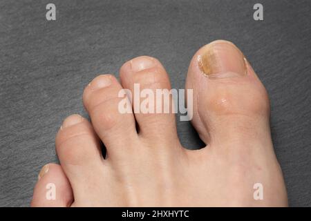 Zehennägel mit Pilzproblemen, Onychomykose, auch bekannt als Tinea unguium, ist eine Pilzinfektion des Nagels, grauer Tisch. Stockfoto