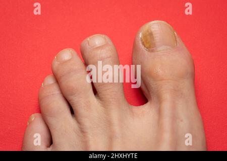 Zehennägel mit Pilzproblemen, Onychomykose, auch bekannt als Tinea unguium, ist eine Pilzinfektion des Nagels, roter Tisch. Stockfoto