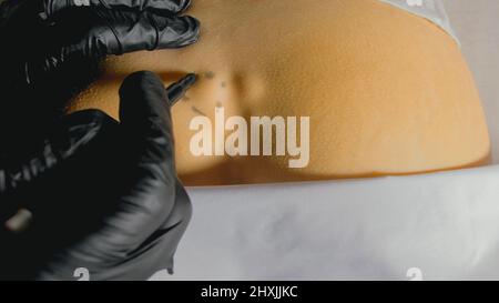 Bruch des Steißbeins der Wirbelsäule. Externe ärztliche Untersuchung durch einen Arzt. Die Hände mit Handschuhen zeigen ein Trauma. Kreuzbein und Steißbein ragen hervor und sind deutlich sichtbar. Stockfoto