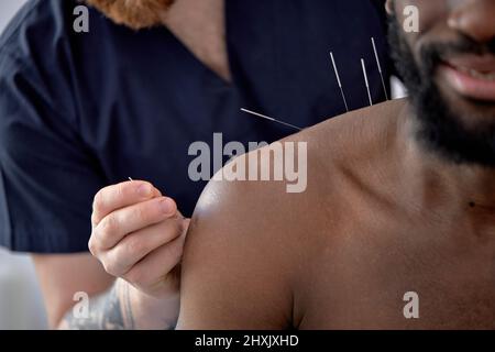 Akupunkturtherapie auf Rückenrückenschultern für schwarze Klientin. Kurzer junger Mann, der sich einer Akupunkturbehandlung mit einer Reihe feiner Nadeln unterzogen hat Stockfoto