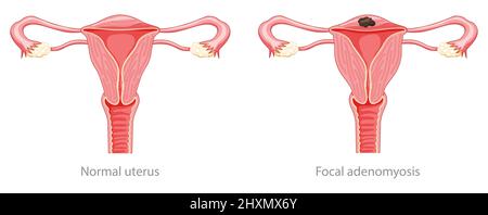 Fokale Adenomyose menschliche Anatomie Kranke weibliche und normale Organe des Fortpflanzungssystems. Ortsschema Querschnitt Gebärmutterhals, Gebärmutterhals, Eierstock, Eileiter-Symbol. Vektorgrafik isoliert auf Weiß Stock Vektor