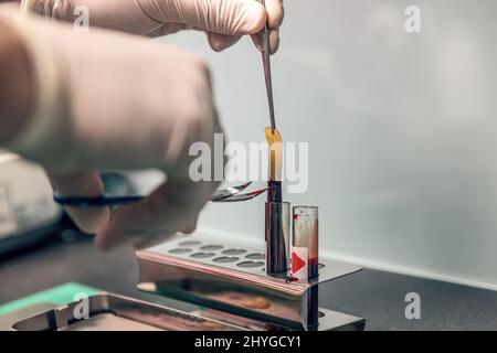 Die plättchenreiche Fibrin-Anwendung wird heute häufig verwendet, um den Heilungsprozess nach dem Eingriff zu beschleunigen Stockfoto