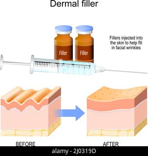 Dermaler Füllstoff. Füllstoffe in die Haut injiziert, um in Gesichtsfalten füllen helfen. Querschnitt der Haut vor und nach der Injektion. Spritze Stock Vektor