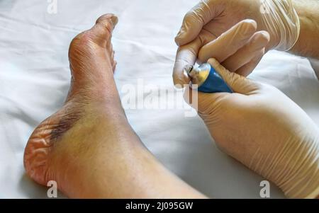 Der Arzt schmiert das verletzte Bein des Patienten mit Gel. Stockfoto