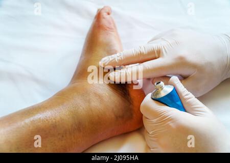 Der Arzt schmiert das verletzte Bein des Patienten mit Gel. Stockfoto