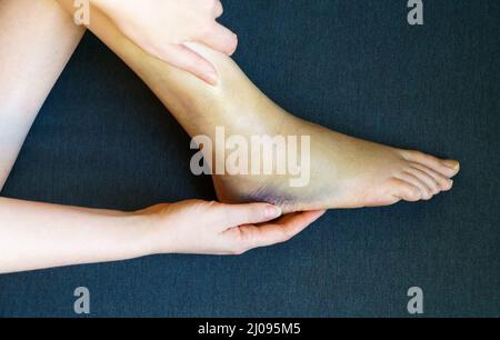 Weibliches Bein mit Prellungen und Schwellungen. Stockfoto