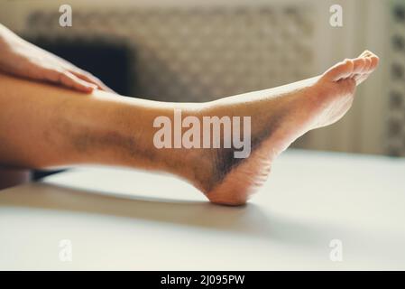 Weibliches Bein mit Prellungen und Schwellungen. Stockfoto