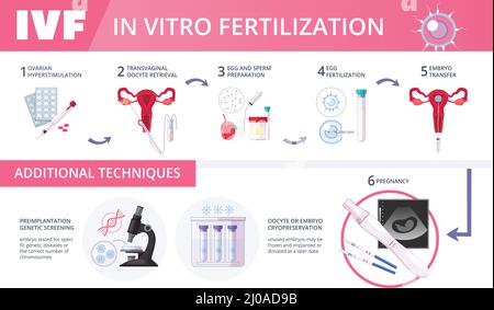 Farbige in-vitro-Fertilisation IVF flache Infografiken mit Schritten von Zusätzliche Techniken Vektordarstellung Stock Vektor