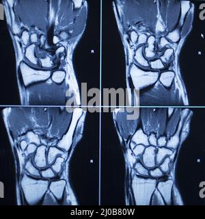 Der MRT-Scan-Test führt zu Verletzungen der Handgelenke Stockfoto