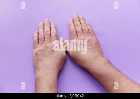 Zeigt Vitiligo Problem Hände auf lila Hintergrund. Pigmentationsproblem der Haut. Hochwertige Fotos Stockfoto