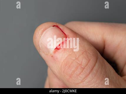 Blutiger Daumen vom Nagel beißen. Nahaufnahme der erwachsenen weiblichen Hand mit frisch gekauter Fingernagel und kleinen Wunden auf der umgebenden Haut. Stockfoto