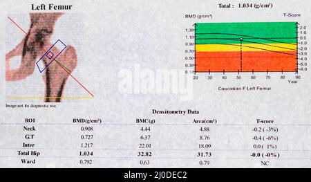 DEXA Densitometry Report of Left femoral Scan; Diagramm und Kurve der Werte ​​used zur Untersuchung der Osteoporose bei Frauen in der Menopause Stockfoto