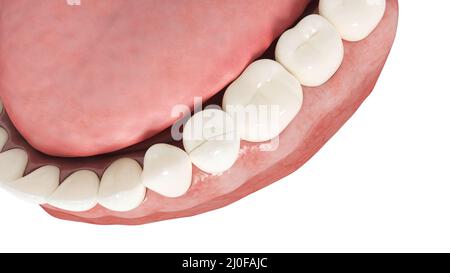 Gebrochene Zähne, Abbildung Stockfoto