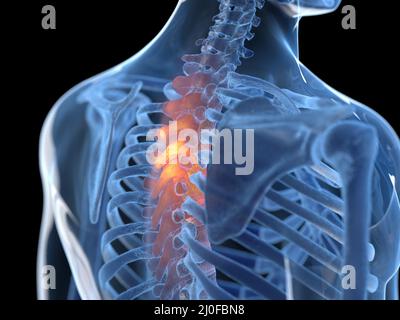 Schmerzhafte Brustwirbelsäule, Illustration Stockfoto