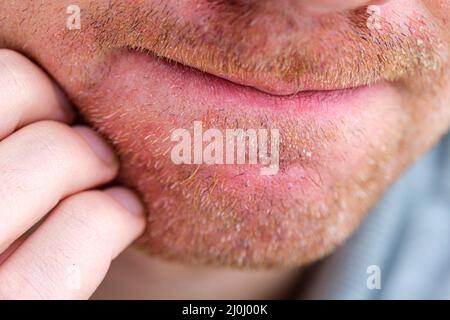 Mann kratzt sich im Gesicht. Seborrhoische Dermatitis oder Ekzeme bei erwachsenen Männern Gesicht isoliert Nahaufnahme. Stockfoto