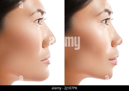 Transformation der asiatischen Frau. Ergebnis einer plastischen Operation. Stockfoto