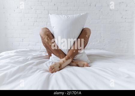 Frau mit Vitiligo hält Kissen zwischen den Beinen auf dem Bett vor der weißen Wand Stockfoto