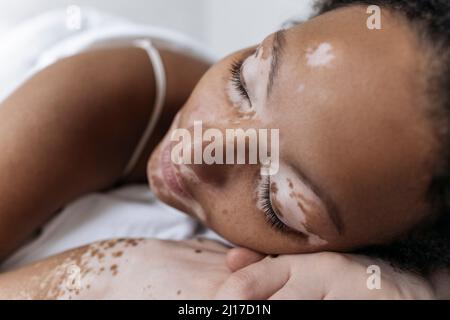 Frau mit Vitiligo schlafen zu Hause Stockfoto