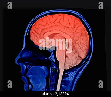 Kolorierte Version eines Magnetresonanzbildes des menschlichen Gehirns. Sagittale Ansicht. Zeigt den Kopf, den Hippocampus, das Zerebellum und das Rückenmark. Achtung. Stockfoto