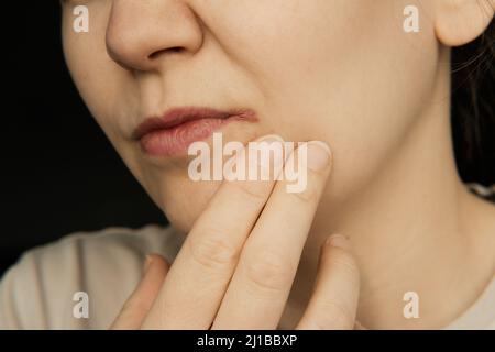 Lippenherpes und Winkelcheilitis auf dem Gesicht der Frau. Schönheit Haut weibliches Gesicht. Gesichtsbehandlung für Mädchen. Gesichtspflege. Dermatologie, Kosmetologie. Natürlich Stockfoto