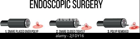Abbildung zeigt die Illustration einer endoskopischen Operation Stock Vektor