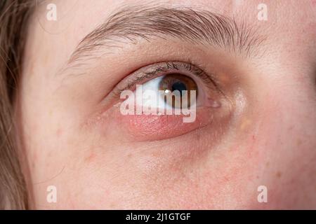 Äußeres Chalazion oder Hordeolum (Stie), auf dem Augenlid einer kaukasischen Frau Stockfoto