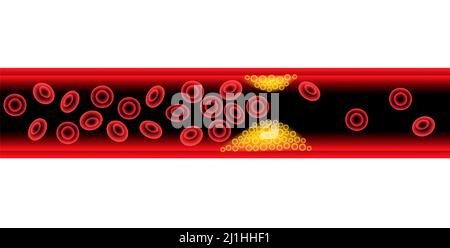 Arteriosklerose, Abbildung Stockfoto