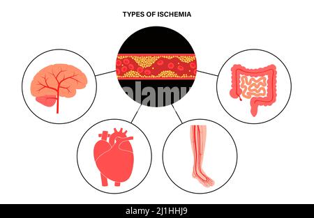 Typen der ischämischen, Illustration Stockfoto