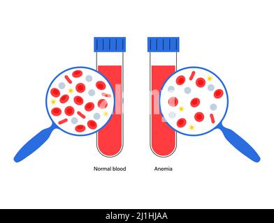 Normales Blut und anämisches Blut, Illustration Stockfoto