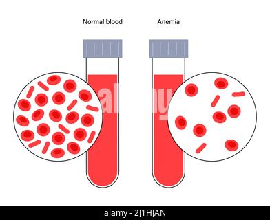 Normales Blut und anämisches Blut, Illustration Stockfoto