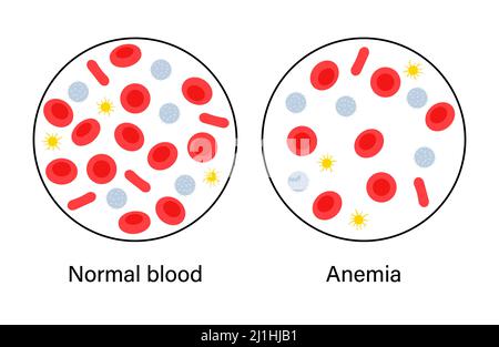 Normales Blut und anämisches Blut, Illustration Stockfoto