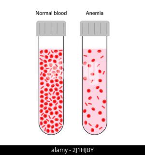 Normales Blut und anämisches Blut, Illustration Stockfoto